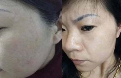 妊娠斑和黄褐斑的区别