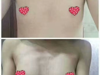 那里做丰胸效果手术好 