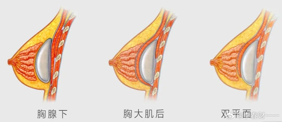 填充自体脂肪丰胸多少钱 